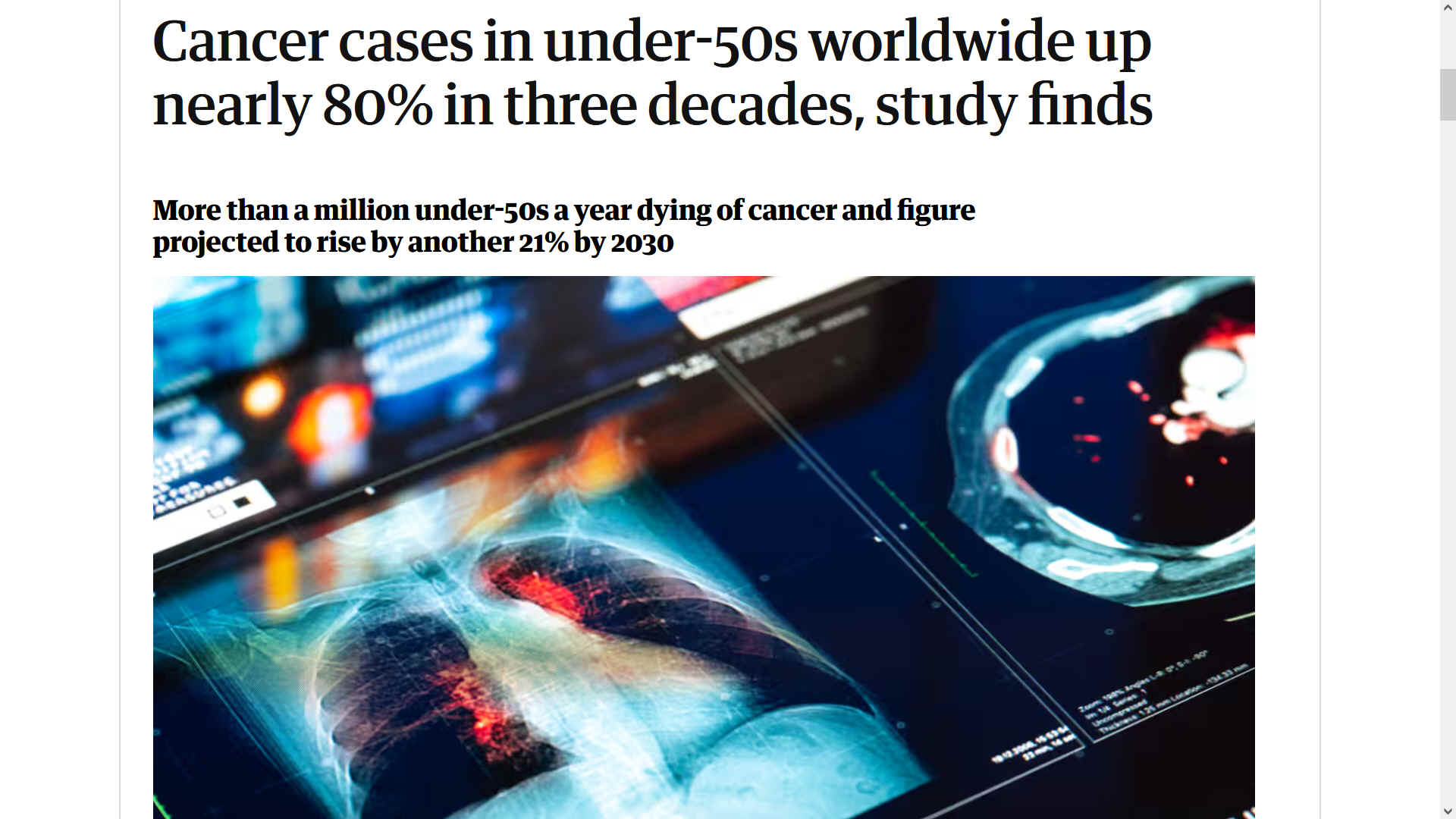 Global cases of early onset cancer increased from 1.82 million in 1990 to 3.26 million in 2019, while cancer deaths of adults in their 40s, 30s or younger grew by 27%. More than a million under-50s a year are now dying of cancer, the research reveals.